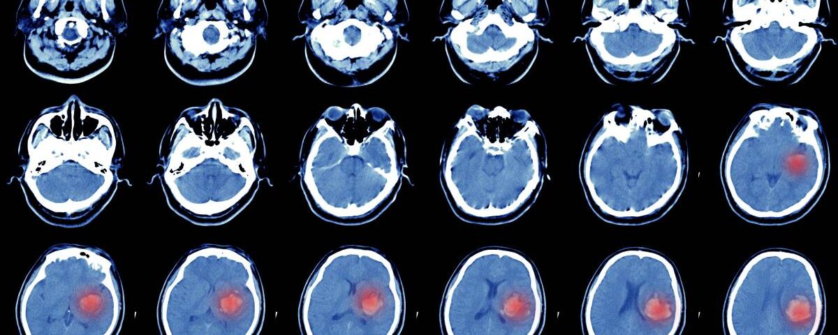 A series of cross-sections of a human brain, several of which show a red splotch, indicating hemorrhagic stroke.