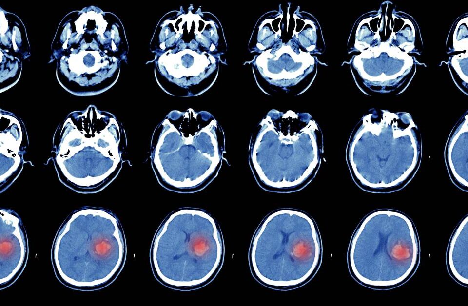 A series of cross-sections of a human brain, several of which show a red splotch, indicating hemorrhagic stroke.