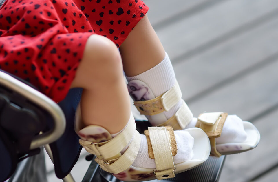 A small child in a red dress with black hearts buckled into a wheelchair. There are braces on both of the child's legs.