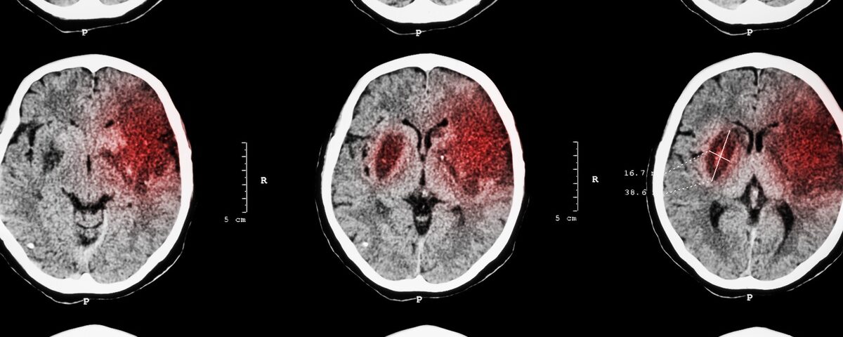 A CT scan of a person’s brain shows the progression of a blood clot that affects the front right section of the brain.