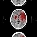 A CT scan of a person’s brain shows the progression of a blood clot that affects the front right section of the brain.