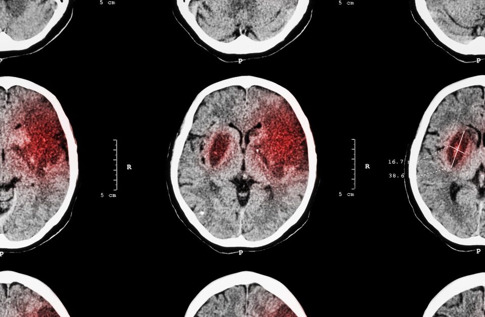 A CT scan of a person’s brain shows the progression of a blood clot that affects the front right section of the brain.